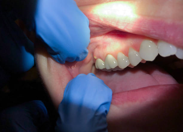 Best Emergency Broken Tooth Repair in Follansbee, WV